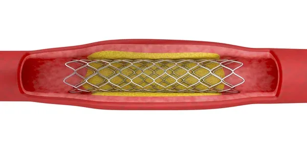 dessin en 3d d’un stent médicamenteux dans un artère.