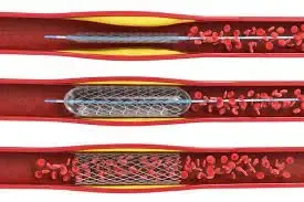 Processus de pose d’un stent en 3D avec 3 étapes dessinés, avec également le gonflement du ballonet
